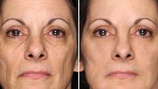 equinox-before-after-620x350-1